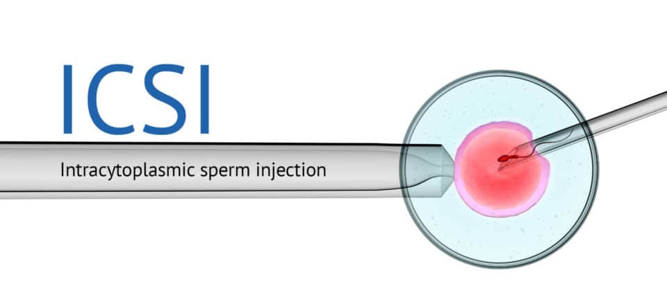 ICSI - a beginner's guide | City Fertility