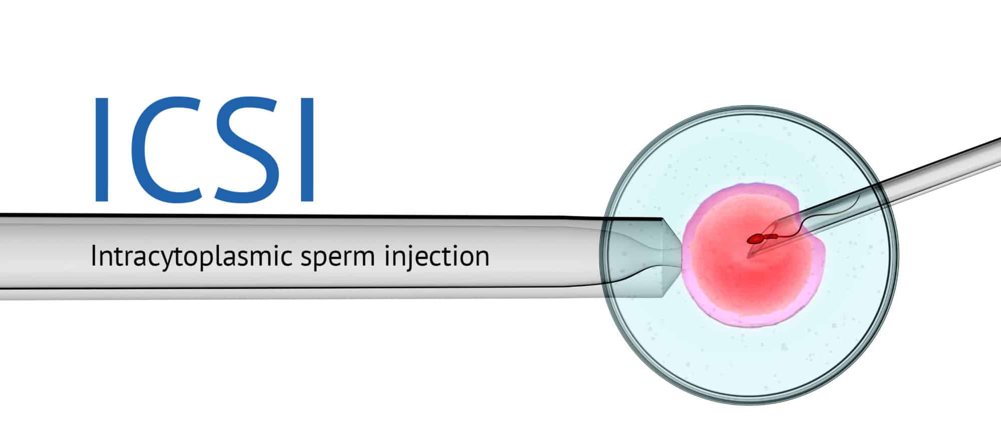 ICSI - a beginner's guide | City Fertility