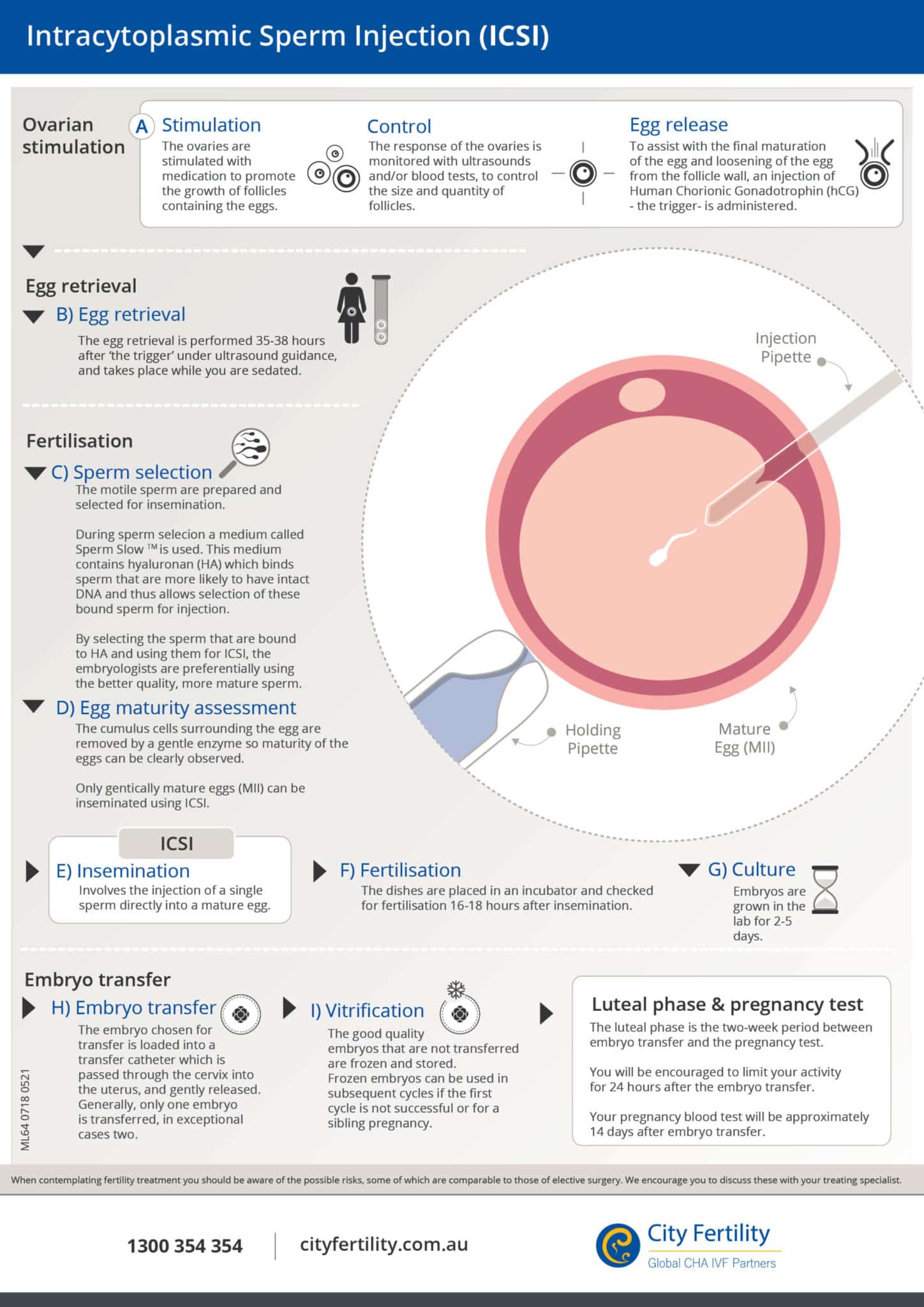 ICSI (Intracytoplasmic Sperm Injection) | City Fertility